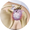 Adhesive Capsulitis
