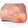 Plantar Fasciitis