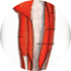 IT Band Stiffness